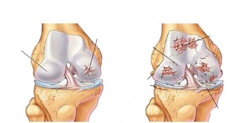 liječenje deformirajuće artroze koljena 3 stupnja kako izliječiti bol u koljenu
