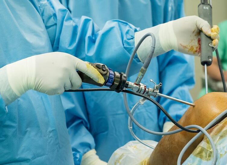 Artroskopia - operacja w chorobie zwyrodnieniowej stawu kolanowego