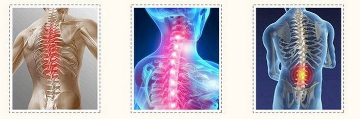 osteochondroza różnych kręgosłupa