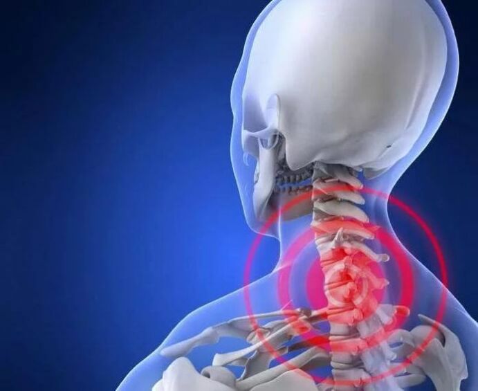 Co to jest osteochondroza