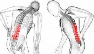 Przepuklina międzykręgowa - powikłanie osteochondrozją