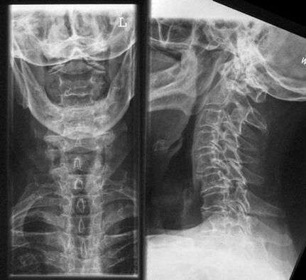 Metoda diagnozy osteochondrozy