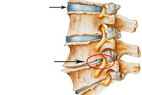 Normalny i uszkodzony kręgosłup z osteochondrozą szyjki macicy