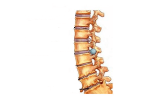 Uszkodzenie kręgosłupa osteochondrozą szyjki macicy