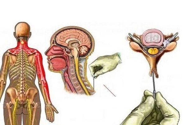 leczenie osteochondrozy szyjnej za pomocą akupunktury