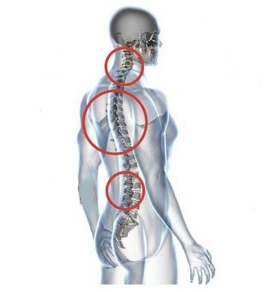 miejsca osteochondrozy kręgosłupa