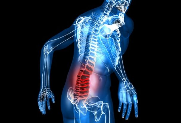 co to jest osteochondroza lędźwiowa