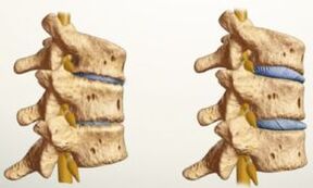 jak wygląda osteochondroza