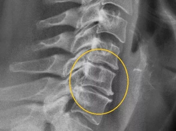 Osteochondroza kręgosłupa szyjnego na zdjęciu rentgenowskim